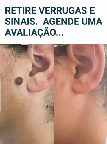 Retire Verrugas e Sinais. Limpeza de Pele Profissional Bem Profunda 