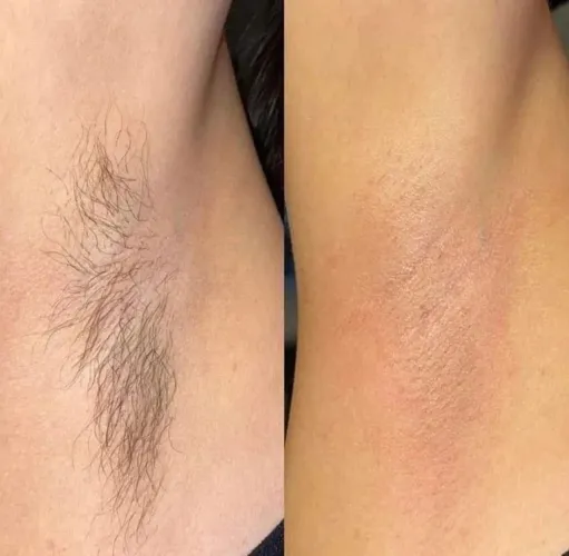 DEPILAÇÃO MASCULINA X FEMININA