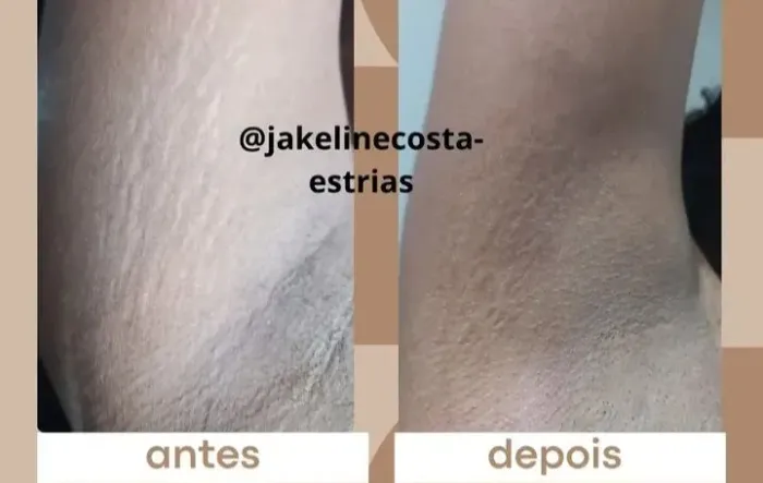 Tratamento de estrias