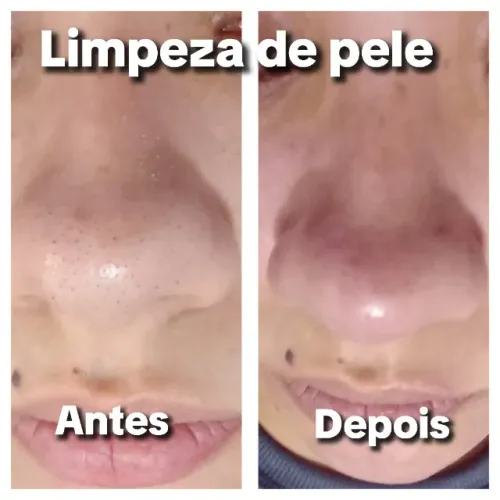 Limpeza de pele