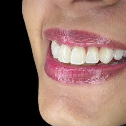 Facetas em resina promoção 