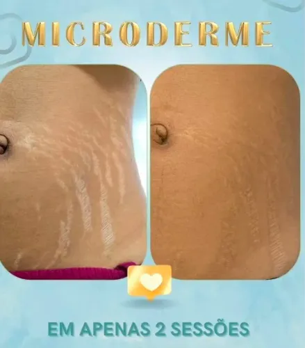 Tratamento em Estrias (modelos)