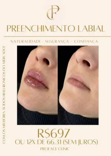 PREENCHIMENTO LABIAl