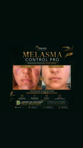 Tratamento Melasma | ARACAJU 