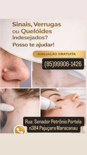 Remoção de sinais e verrugas e cisto cebaceo