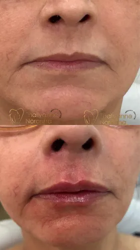 Preenchimento labial 