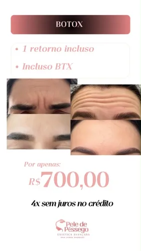 Botox