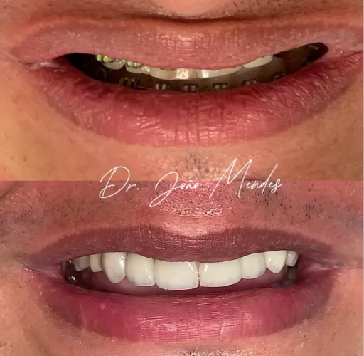Implantes Dentários/ Promoção