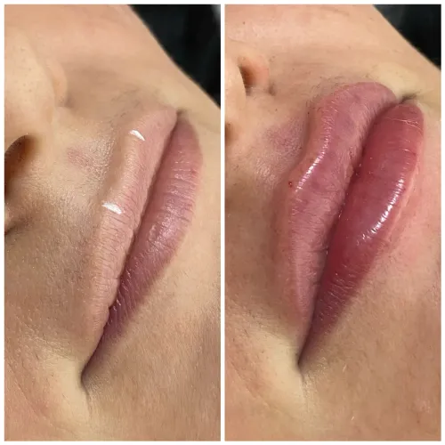 Harmonização facial 