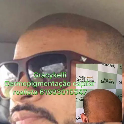 Micropigmentação capilar realista 
