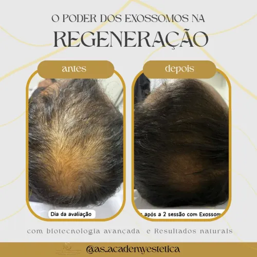 *Tratamento de Alopesia Com a Regeneração*