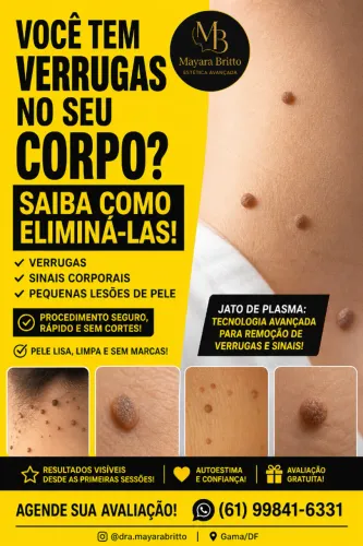 Remoção de verrugas 