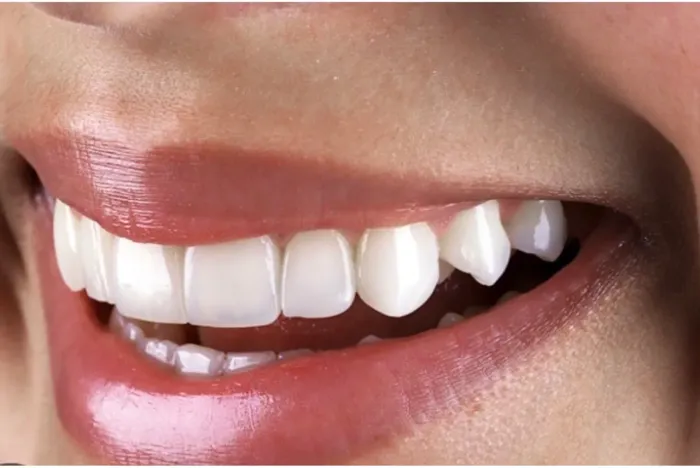 Clareamento dentário a laser 