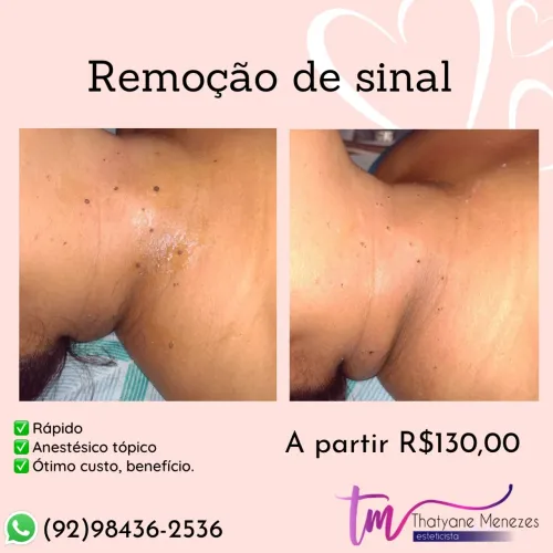Remoção de Sinais 