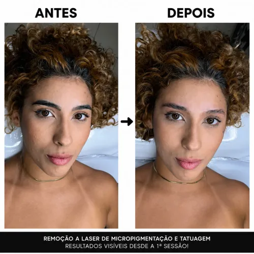 Remoção de Micropigmentação e tatuagem