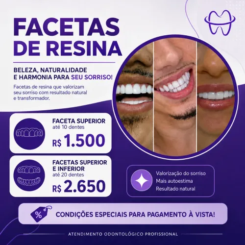 Facetas em resina