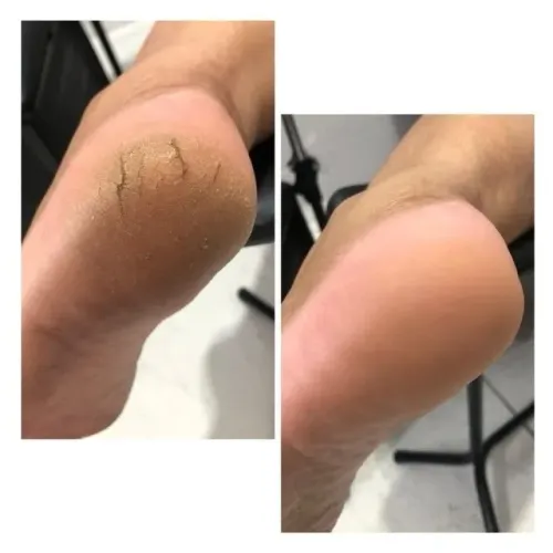 Pés ? sem rachadura