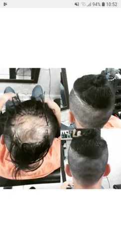 Prótese Capilar Peruca