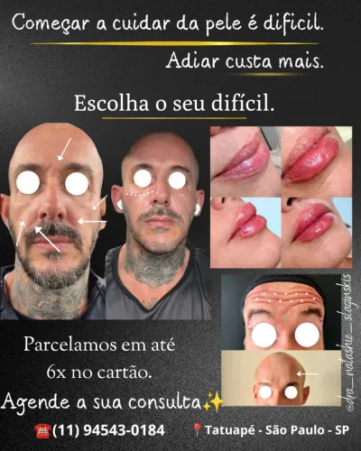 Posicionamento Facial - Harmonização Facial