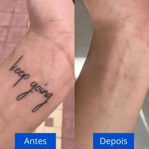 Remoção de tatuagem