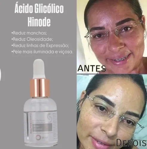  Ácido Glicólico Routine Dermo com Aplicador Hinode.