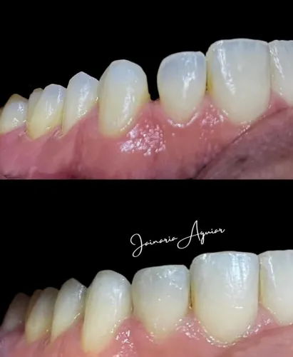 Correção do espaço entre os dentes | Estética do sorriso