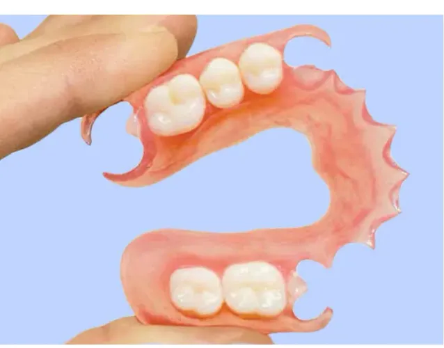Dentadura roach  com ferrinho ponte móvel e flexit