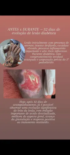 *Laserterapia e fotobiomodulação no cuidado avançado de lesões e curativo domiciliar