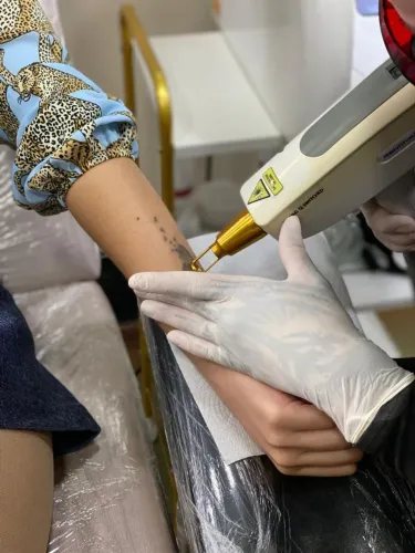 Máquina de Laser NdYag Remoção de Tatuagem ANVISA com acessórios!