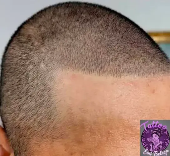 MICROPIGMENTAÇAO CAPILAR 