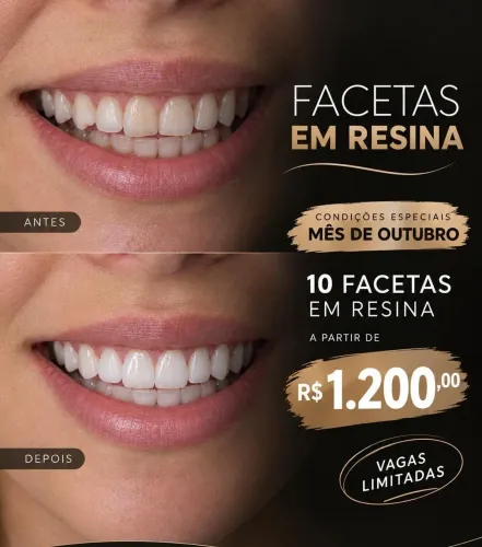 Lentes / Facetas de Resina