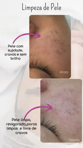 Limpeza de pele