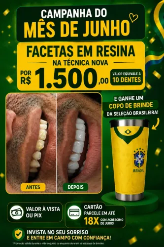 Facetas em resina 