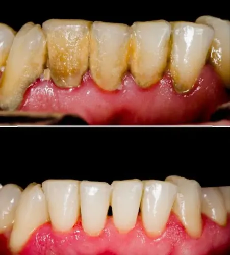 Limpeza e raspagem dental