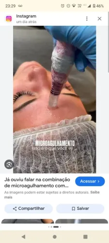 Microagulhamento 