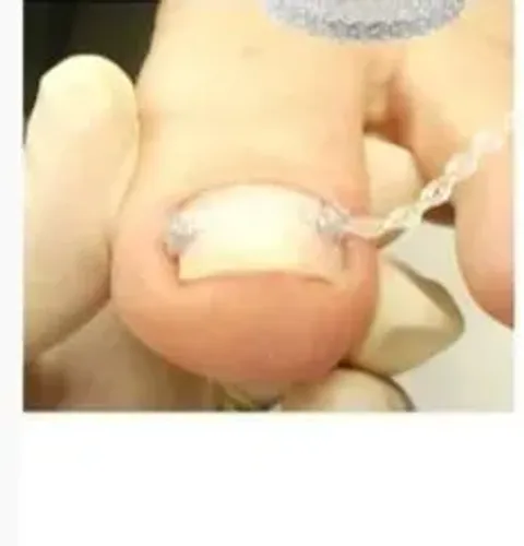 Aparelho Ortodôntico para Unhas - Novo