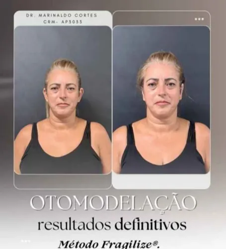 Otomodelação método Fragilize promoção exclusiva 