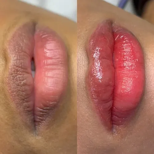 Micro labial pague só o material