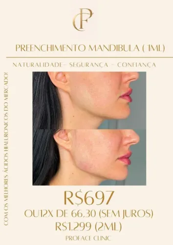 PREENCHIMENTO DE MANDÍBULA