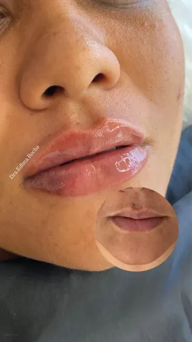 Preenchimento labial com 30% de desconto