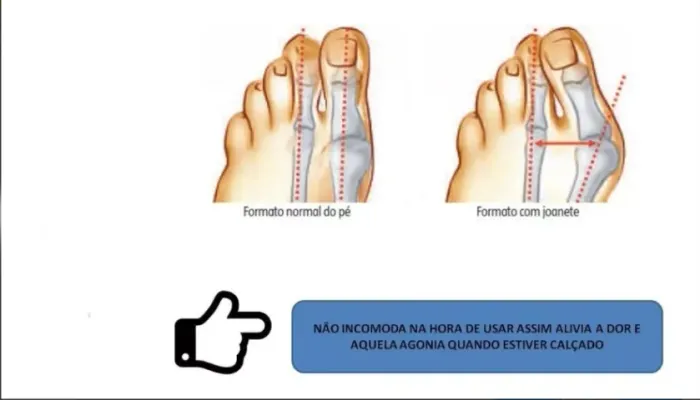 PROTETOR DE JOANETE EM SILICONE - CONFORTO IMEDIATO