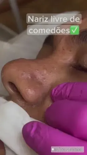 Limpeza de pele profunda