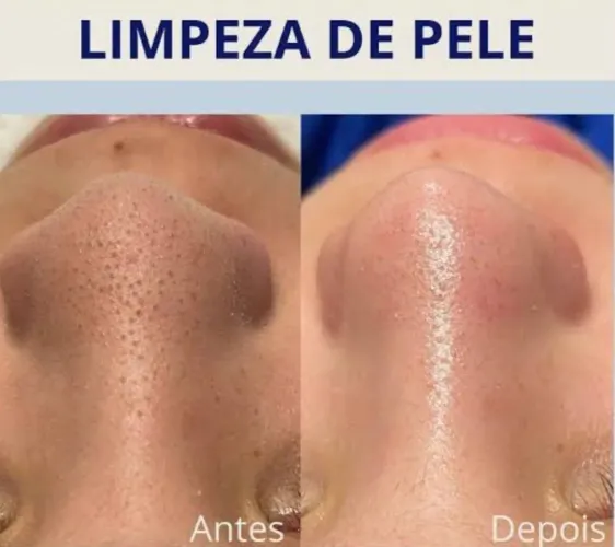 Limpeza de pele profunda com extração ( promoção  )