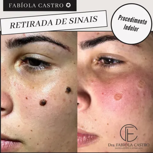 Remoção de sinais | São Luís 