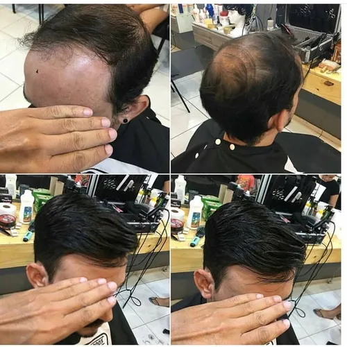 Prótese Capilar Masculino 100% Natural a melhor de São Luís