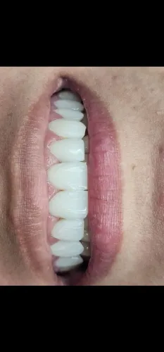 Facetas em Resina Composta R$800,0
