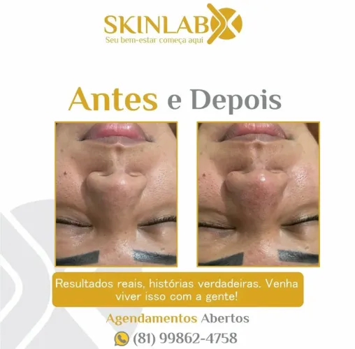 Limpeza de pele profunda