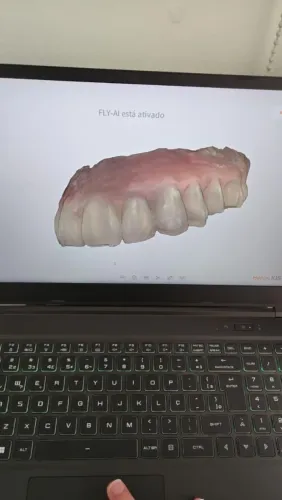 Scanner Intraoral 3D Heron OVO IOS 3Disc