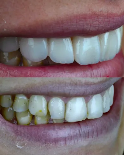 Facetas em Porcelana