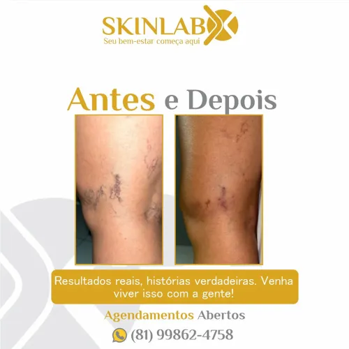 Tratamento para varizes - Resultados incríveis!